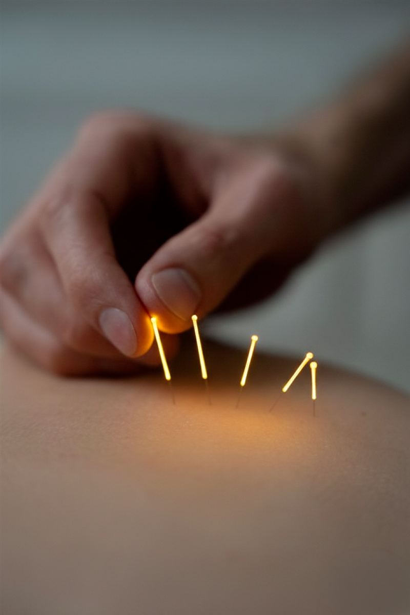 Aiguilles de dry needling insérées dans la peau lors d'une séance